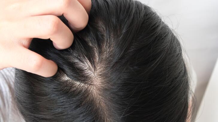 8 Things To Know About Dandruff Causes Remedies