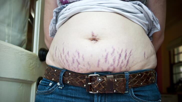 9 Things To Know About Stretch Marks Causes Treatments