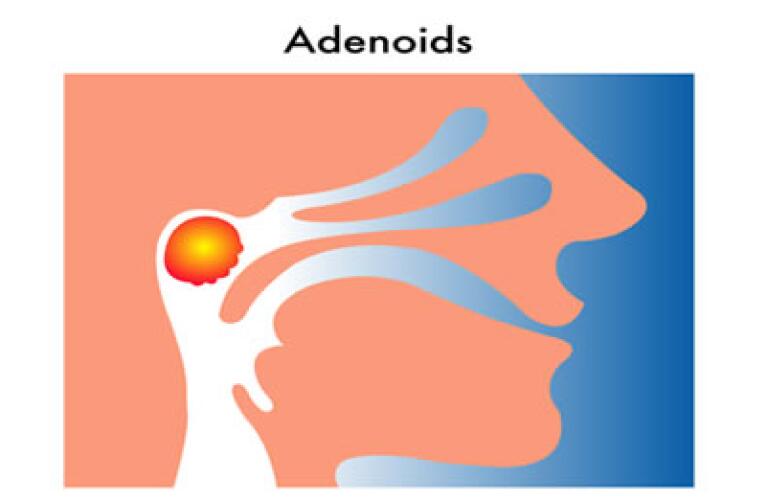 Adenoidectomy