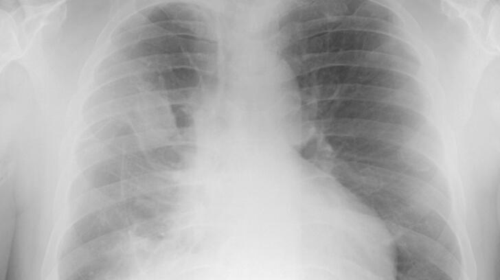 can copd be lung cancer