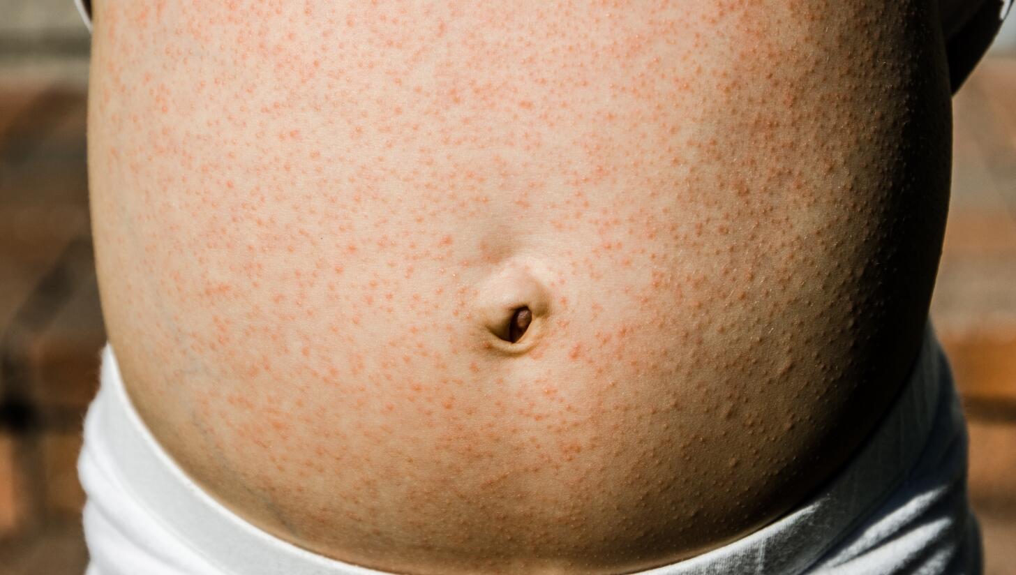 Skin rashes in children