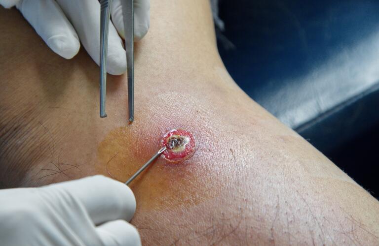 A nurse preparing to dress a drained abscess.