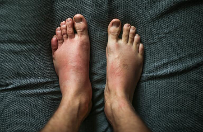 photo of man's swollen foot next to his normal size foot showing symptoms of infection or possible allergic reaction to insect bite or sting