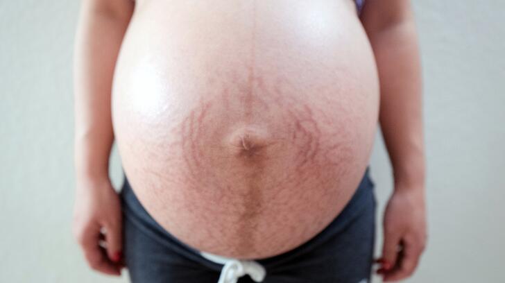 9 Things To Know About Stretch Marks Causes Treatments