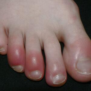Unusual Symptoms of COVID-19 | Loss of Smell | COVID Toes