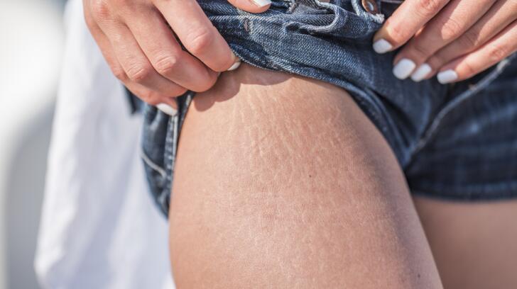 9 Things To Know About Stretch Marks Causes Treatments