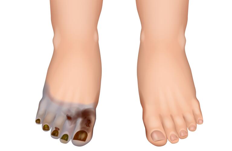 Illustration of gangrene on foot of child