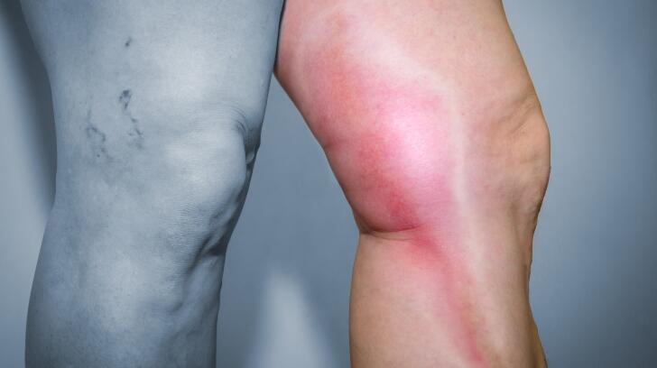 6 Things To Know About Blood Clots