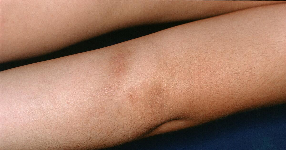 Morphea Facts 5 Things To Know About Morphea