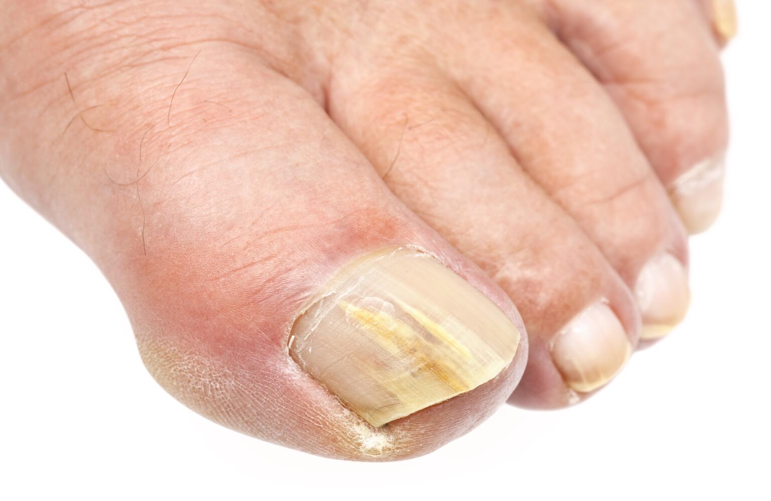 Toenail Problems Fungus, Thickening & Yellow Toenails