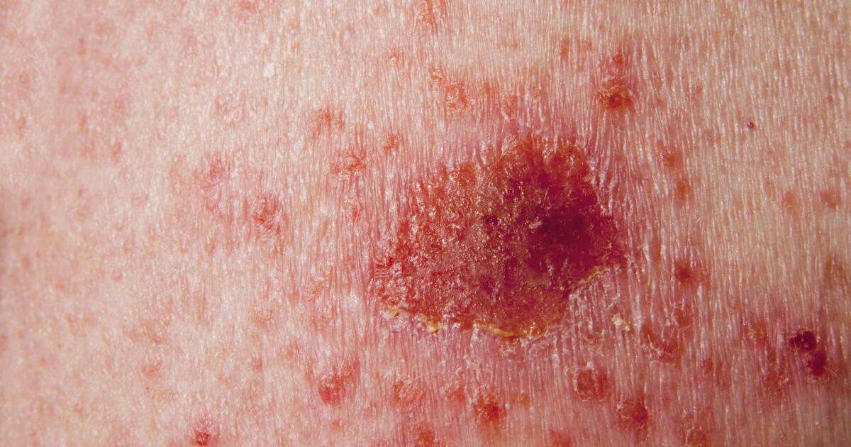images What Is A Scab Made Out Of scabs symptoms causes treatments