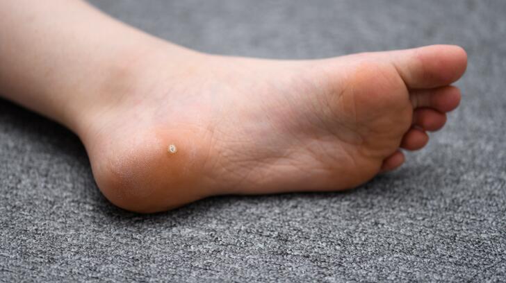 wart on foot inside