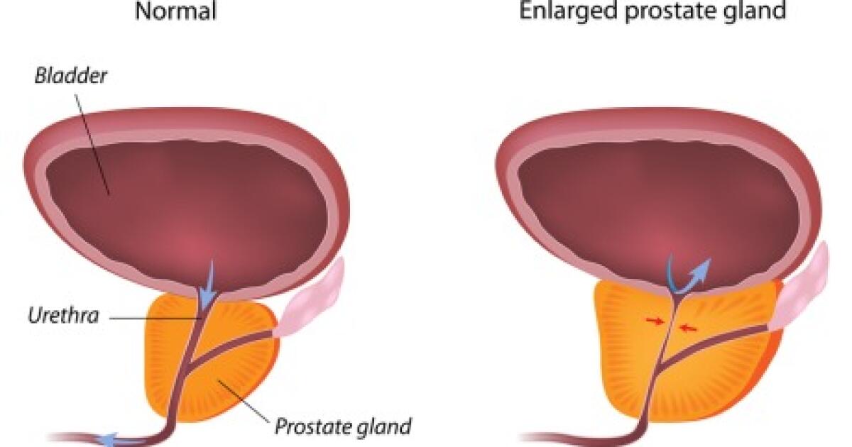 laser prostate surgery vs turp arthritis és arthrosis klinika