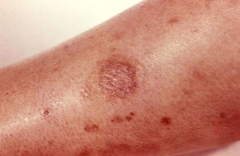 Allergic reaction to spider bite photos
