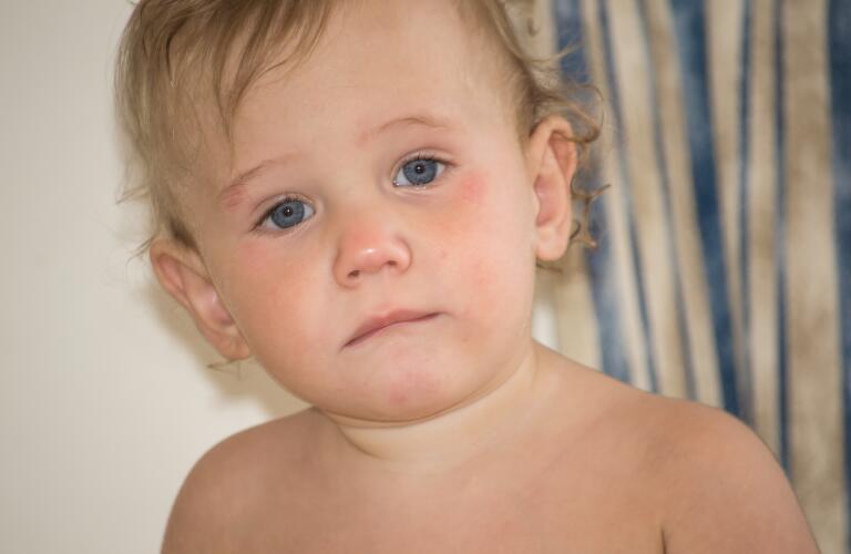 Looking For Food Allergies In Children