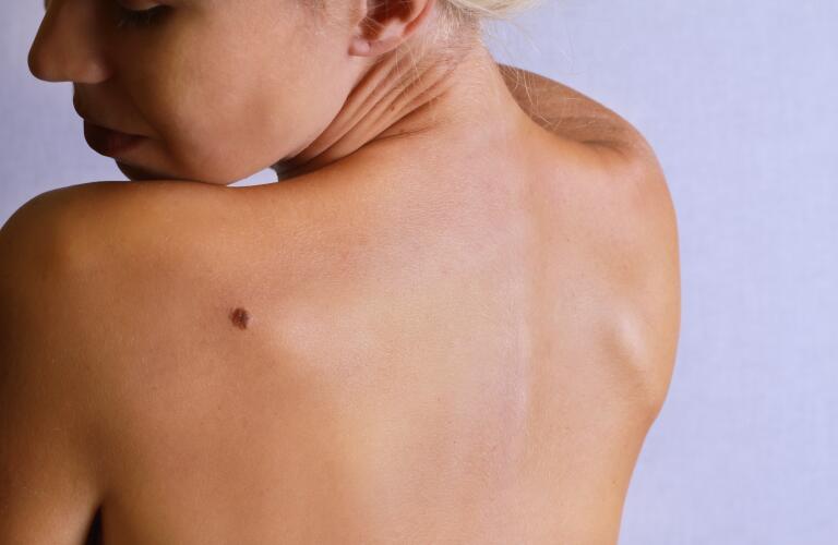Woman with mole on back