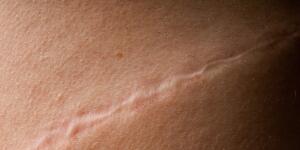 Hidradenitis Suppurativa Symptoms Eczema Complications