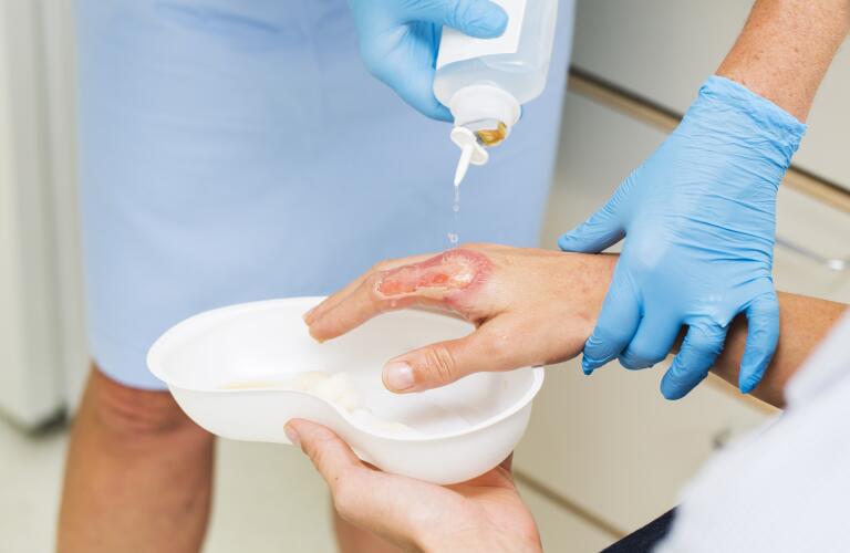nurse pouring water on patient's severe skin burn on index finger - possible 3rd degree burn