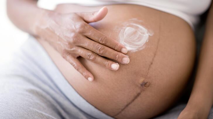 9 Things To Know About Stretch Marks Causes Treatments