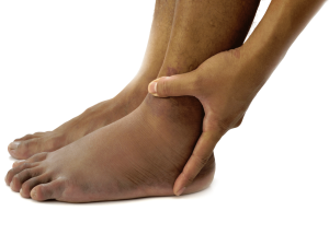 edema symptoms causes treatments