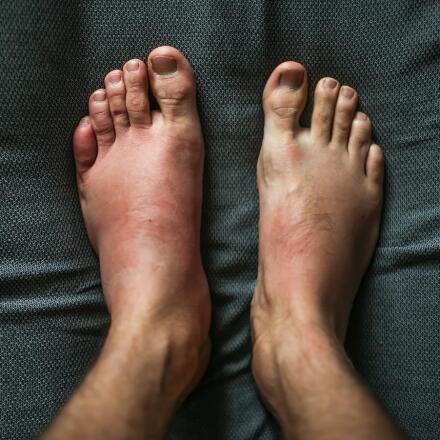 Leg Rash Symptoms Causes Treatments Healthgrades Com