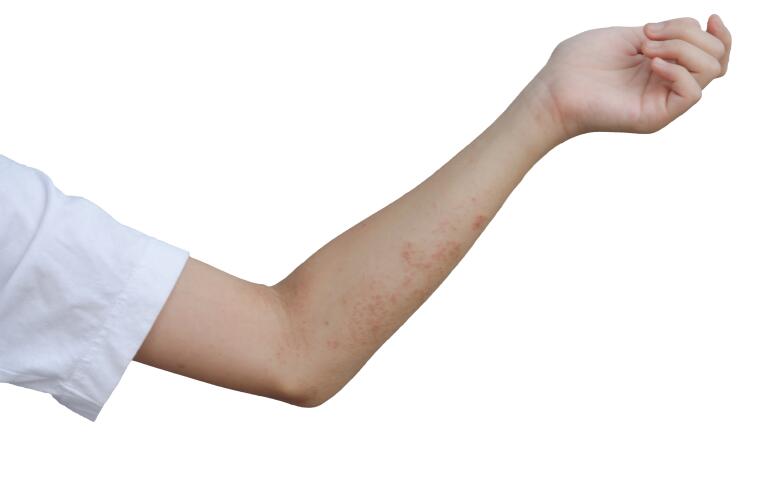 How Do You Get Scabies Frequently Asked Questions About Scabies