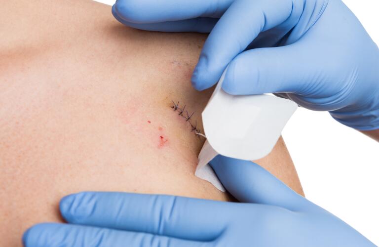doctor hands covering sutured wound after mole removal