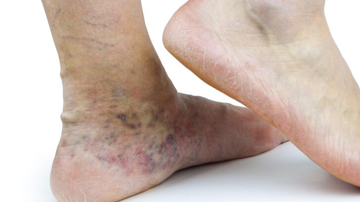 Tratament remedii populare picior varicose