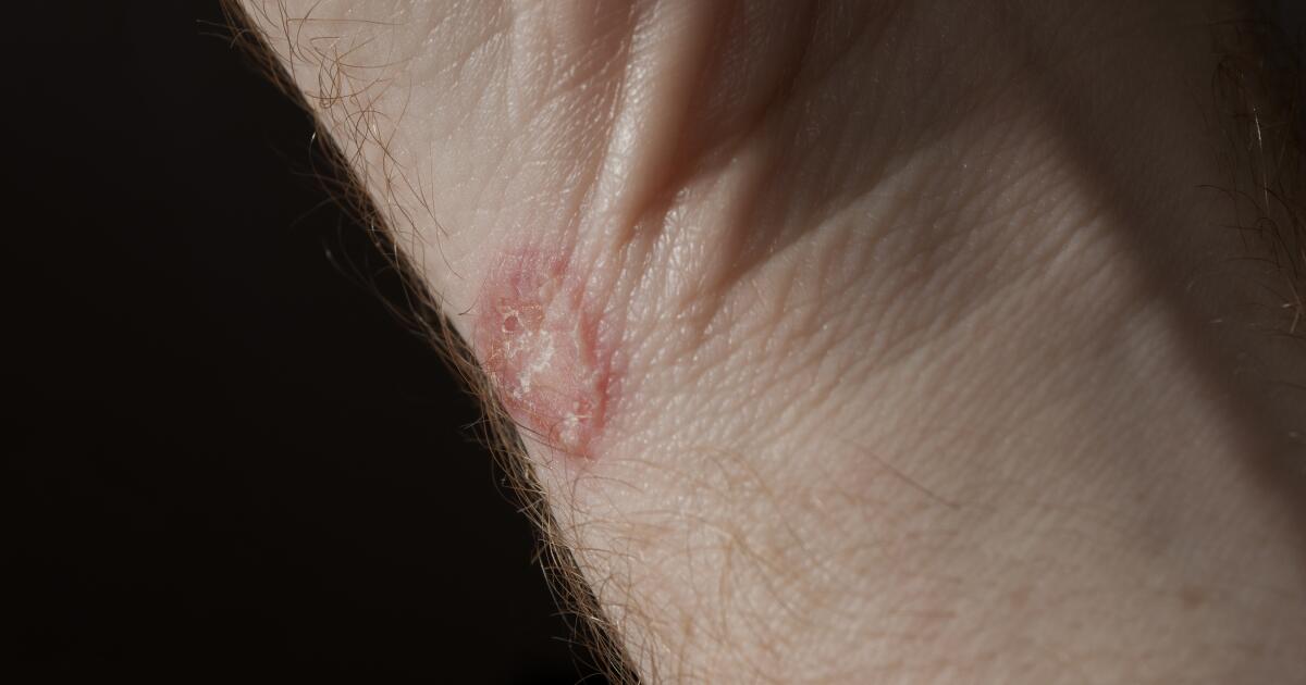 Ringworm Symptoms Causes Risk Factors Treatment Tinea