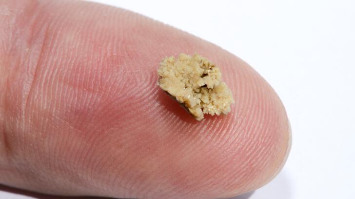 10 Things To Know About Kidney Stones