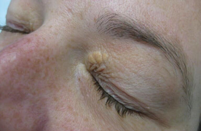 Photo of a xanthoma on the eye