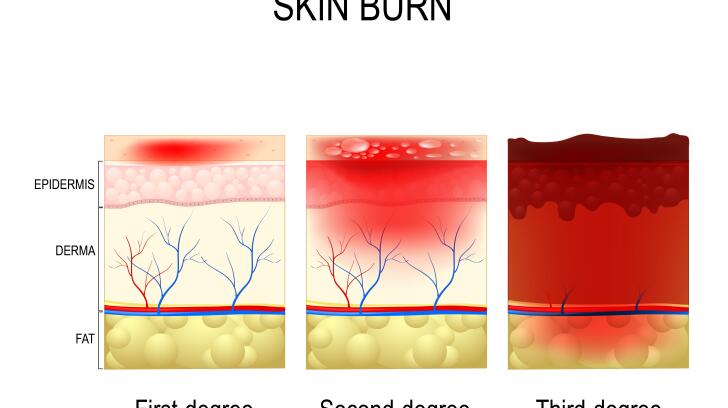 treating second degree sunburn