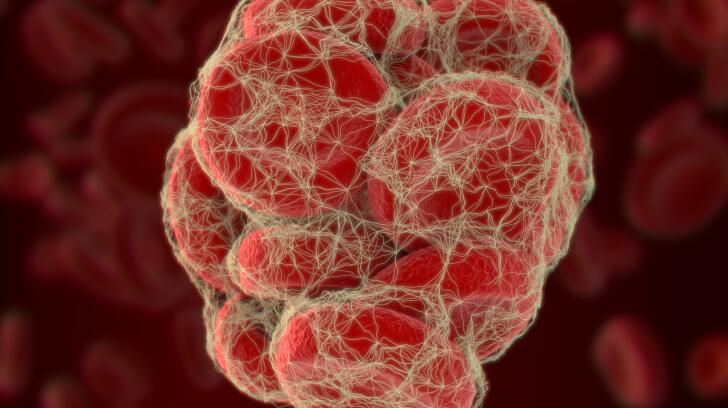 Blood Clot Cramp Or Pulled Muscle How Can I Tell The Difference