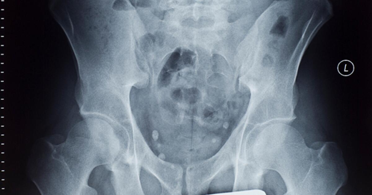 ovarian cancer x ray