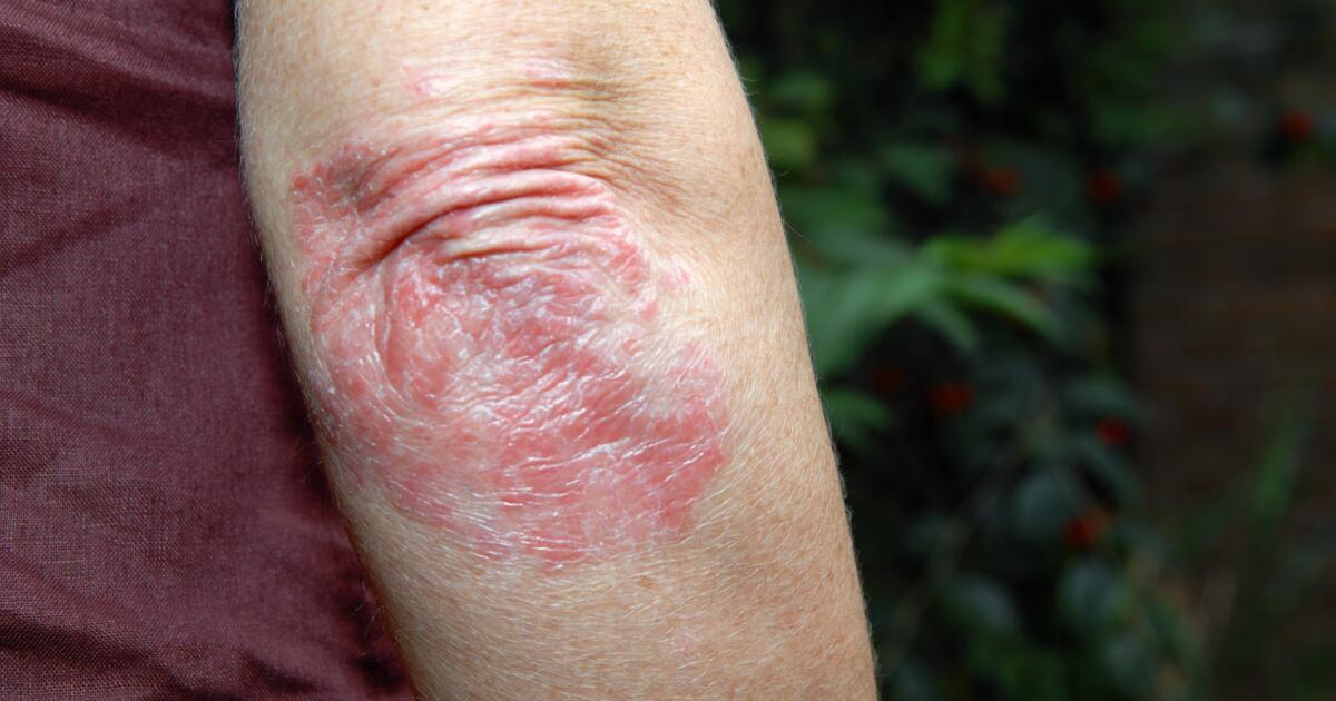 Arm Rash Symptoms Causes Treatments