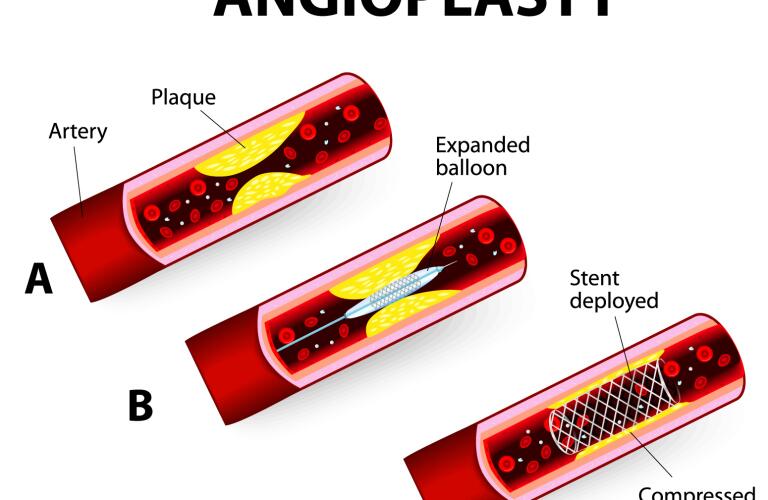 Angioplasty