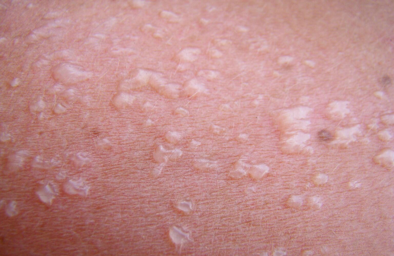 Blisters Symptoms, Causes, Treatments