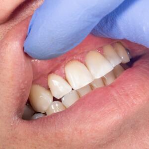 gloved hand lifting upper lip to show tooth decay and poor oral hygiene