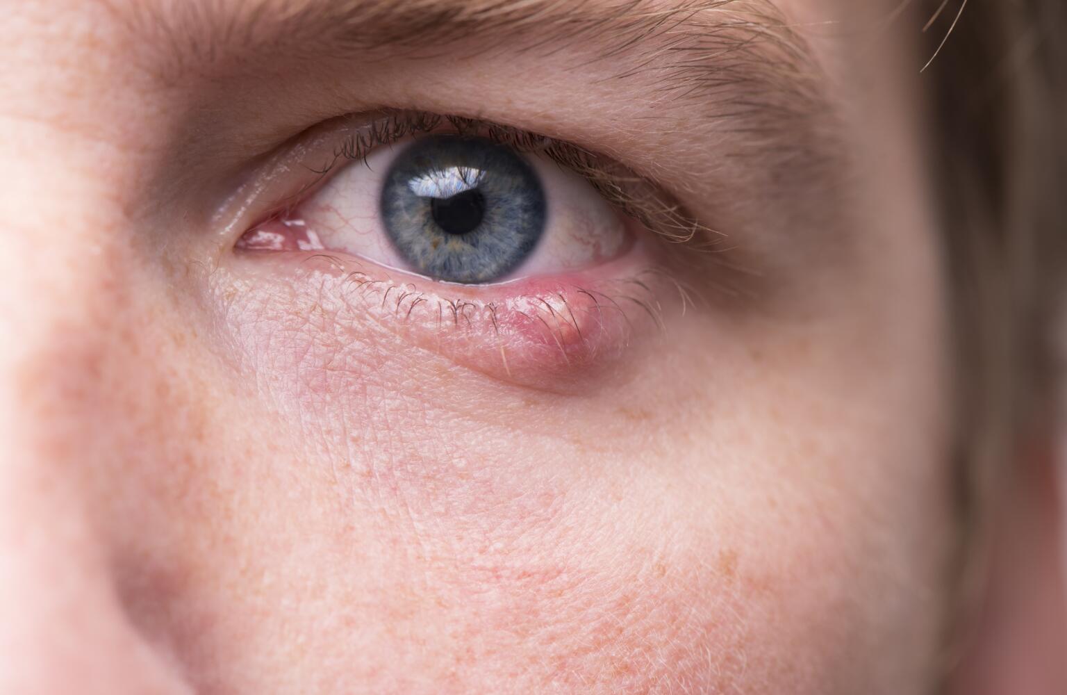 Stye Treatment When to See a Doctor for a Stye in the Eye & Eyelid