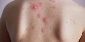 Hidradenitis Suppurativa Symptoms Eczema Complications