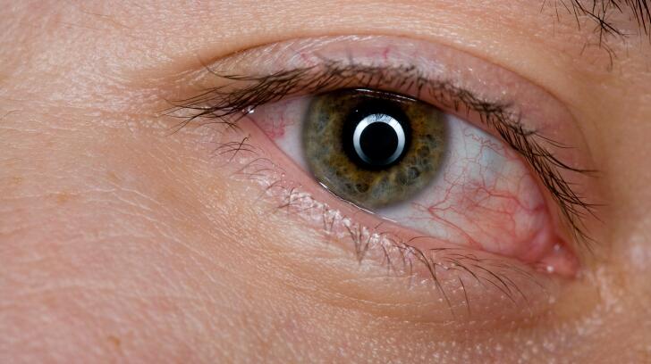 8 Common Eye Symptoms And What They Mean