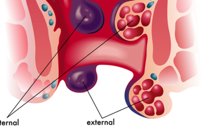 Hemorrhoidectomy
