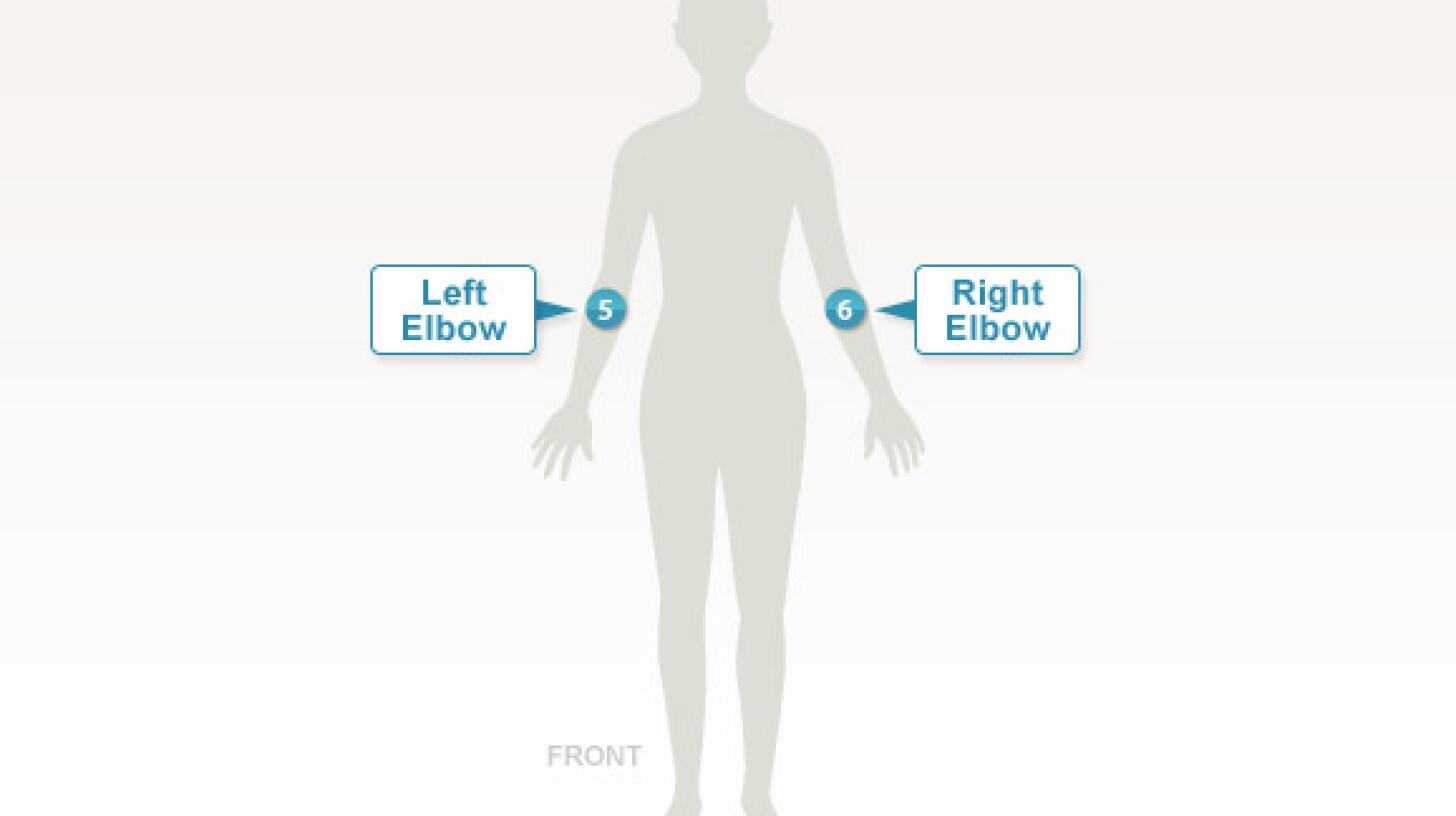 The Tender Points of Fibromyalgia