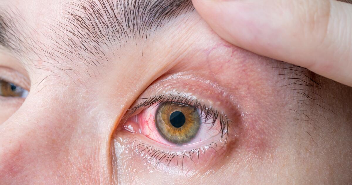 Bloodshot Eyes Bloodshot Eyes