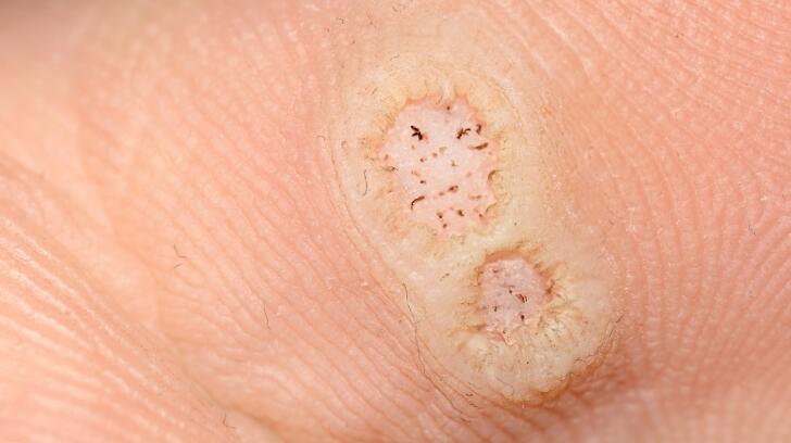 hpv warts in feet