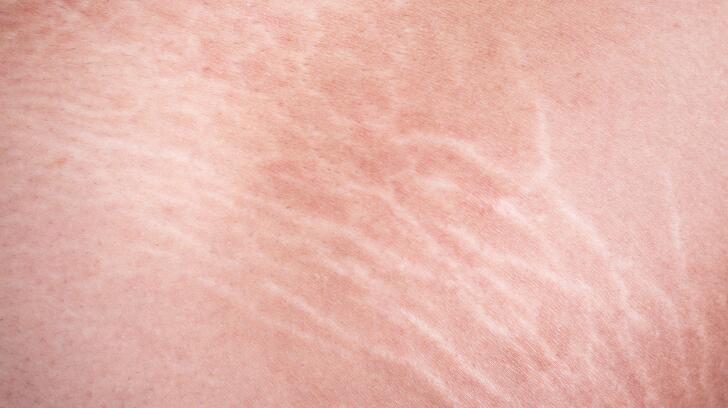 9 Things To Know About Stretch Marks Causes Treatments