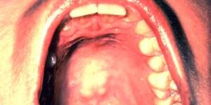 Mouth Cancer Pictures What Oral Cancer Sores Look Like