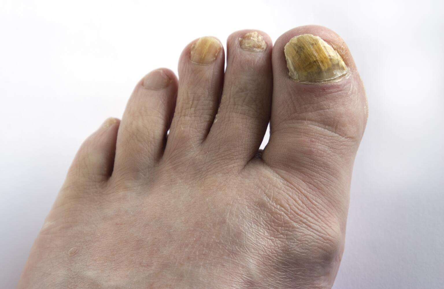 Toenail Problems Fungus, Thickening & Yellow Toenails