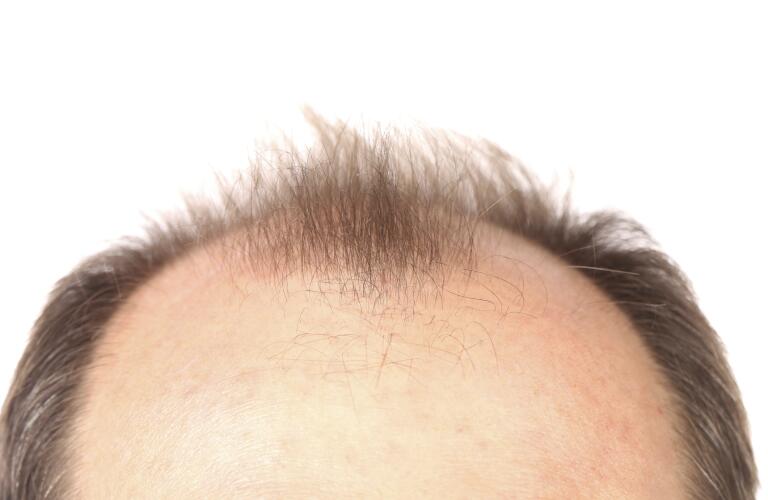 What is Alopecia?