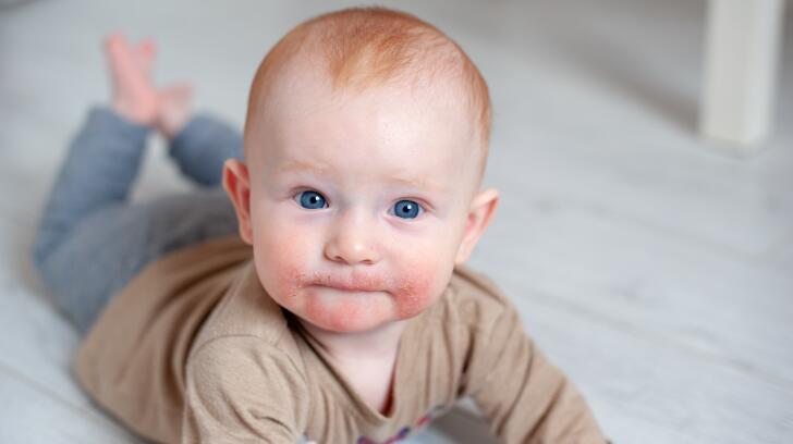 What Eczema Looks Like Eczema On Baby On The Face On The Hands What Eczema Looks Like Eczema On Baby On The Face On The Hands